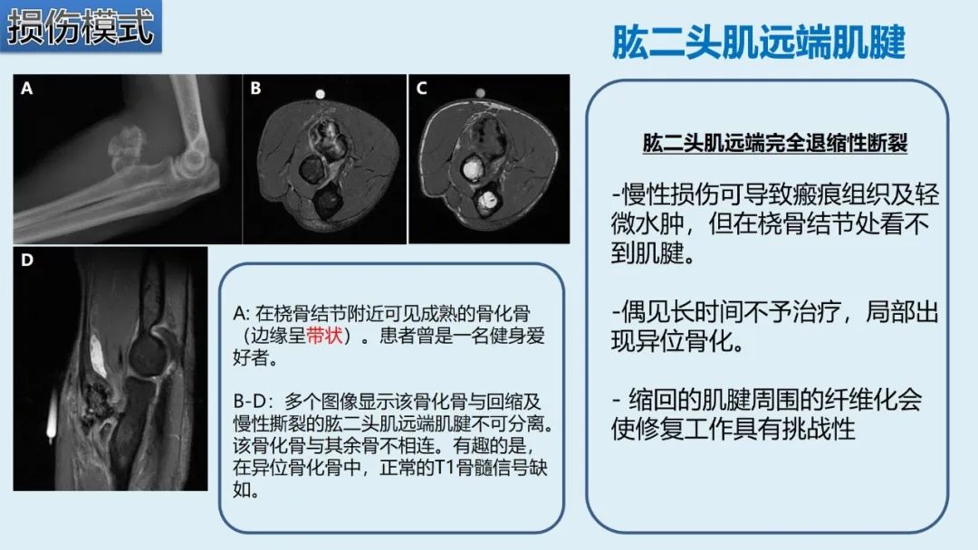 影像PPT - 【PPT】肱二头肌解剖、临床体征及损伤的影像表现-46 影像PPT - 【PPT】肱二头肌解剖、临床体征及损伤的影像表现-46
