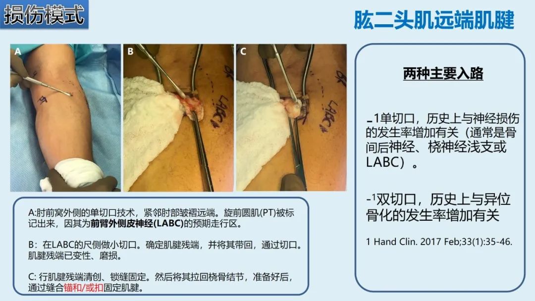影像PPT - 【PPT】肱二头肌解剖、临床体征及损伤的影像表现-48 影像PPT - 【PPT】肱二头肌解剖、临床体征及损伤的影像表现-48