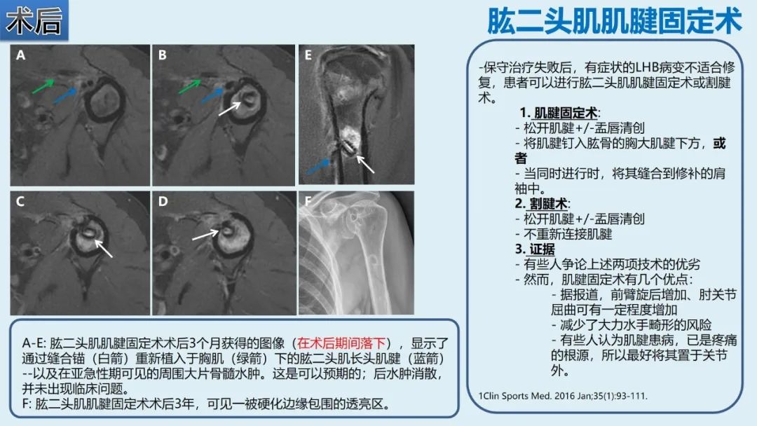 影像PPT - 【PPT】肱二头肌解剖、临床体征及损伤的影像表现-50 影像PPT - 【PPT】肱二头肌解剖、临床体征及损伤的影像表现-50