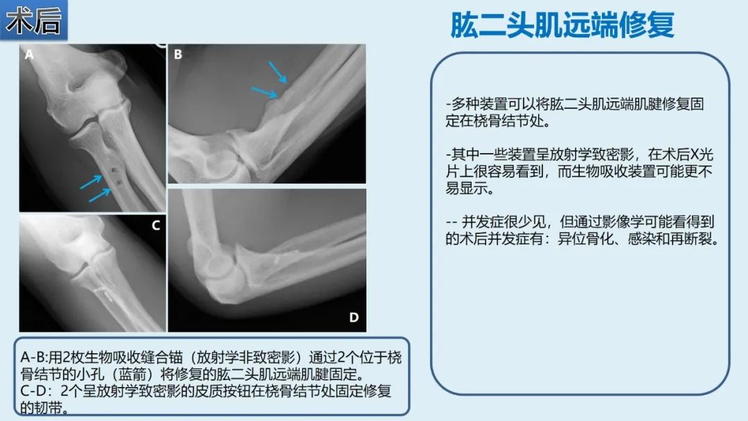 影像PPT - 【PPT】肱二头肌解剖、临床体征及损伤的影像表现-52 影像PPT - 【PPT】肱二头肌解剖、临床体征及损伤的影像表现-52