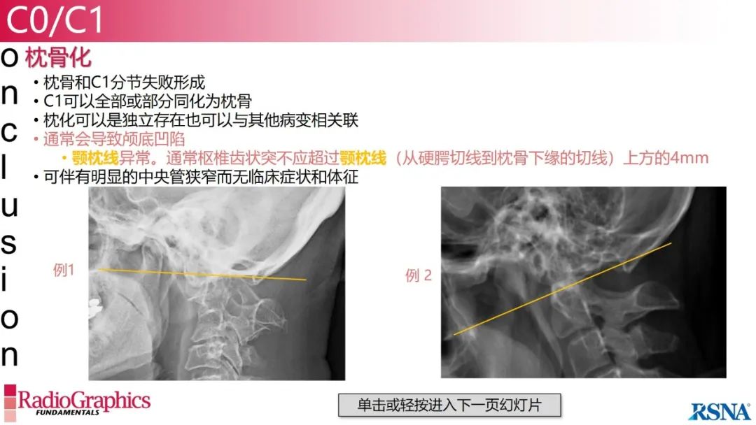 影像PPT - 【PPT】颈椎X线片解读-10 影像PPT - 【PPT】颈椎X线片解读-10