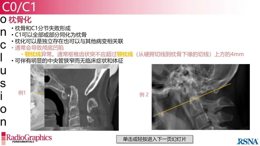 影像PPT - 【PPT】颈椎X线片解读-12 影像PPT - 【PPT】颈椎X线片解读-12