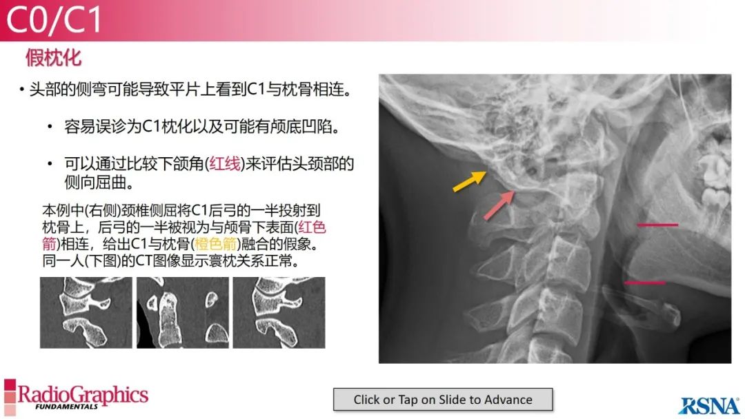 影像PPT - 【PPT】颈椎X线片解读-14 影像PPT - 【PPT】颈椎X线片解读-14