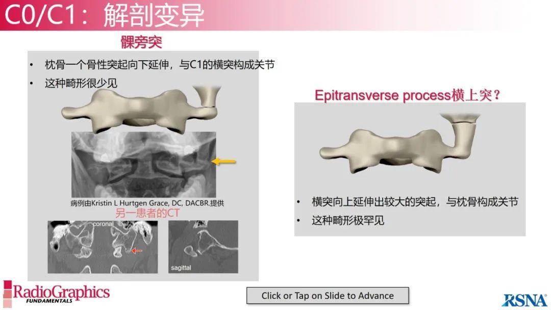 影像PPT - 【PPT】颈椎X线片解读-18 影像PPT - 【PPT】颈椎X线片解读-18
