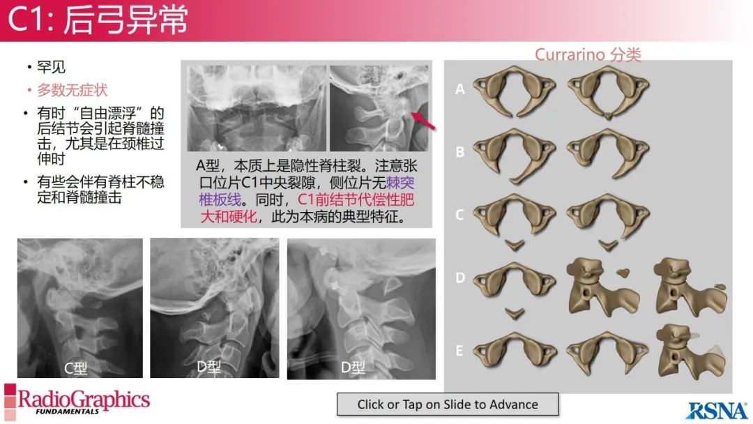 影像PPT - 【PPT】颈椎X线片解读-24 影像PPT - 【PPT】颈椎X线片解读-24