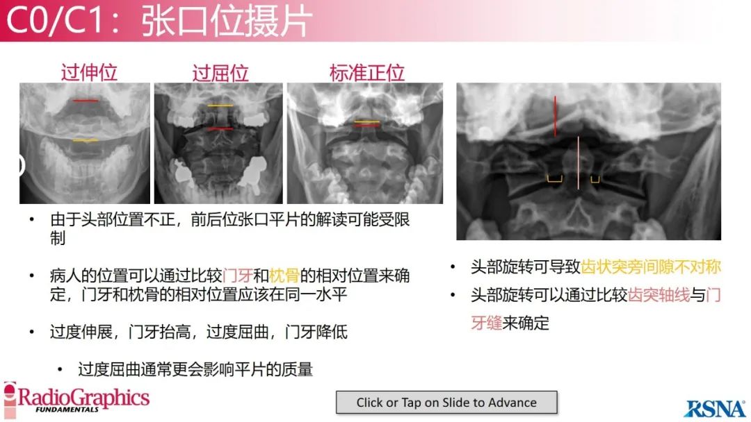 影像PPT - 【PPT】颈椎X线片解读-20 影像PPT - 【PPT】颈椎X线片解读-20