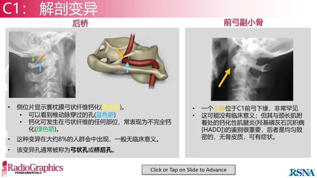 影像PPT - 【PPT】颈椎X线片解读-22 影像PPT - 【PPT】颈椎X线片解读-22