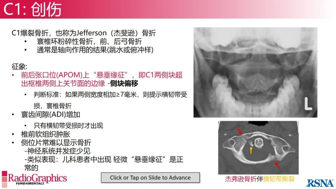 影像PPT - 【PPT】颈椎X线片解读-28 影像PPT - 【PPT】颈椎X线片解读-28