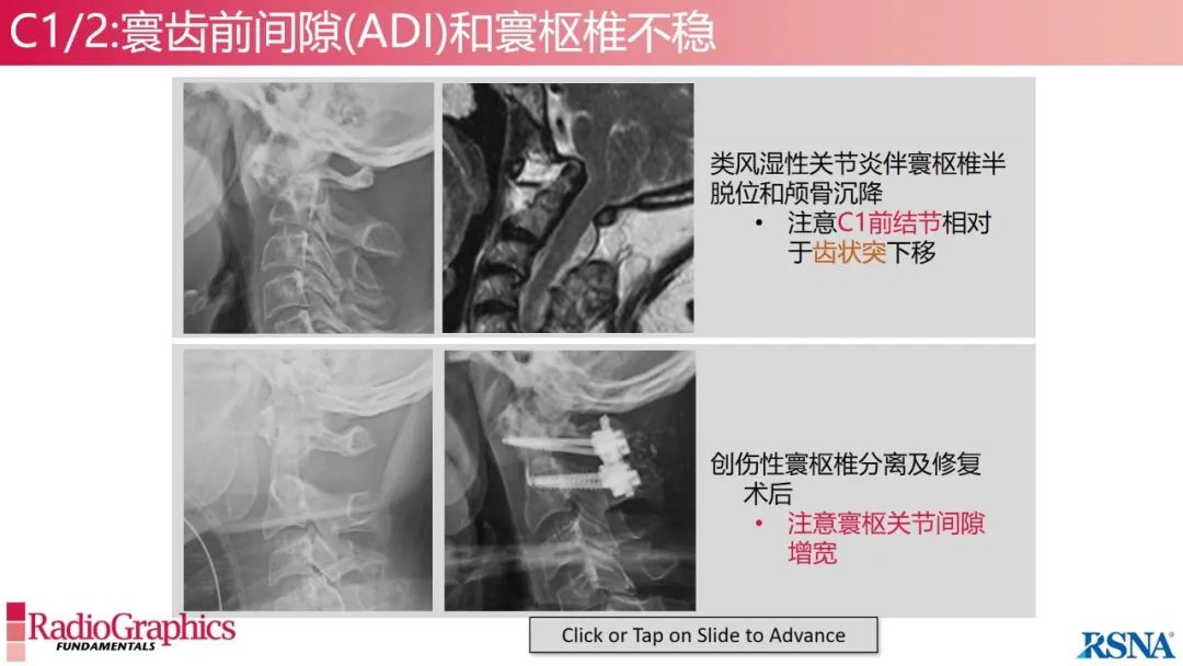 影像PPT - 【PPT】颈椎X线片解读-42 影像PPT - 【PPT】颈椎X线片解读-42
