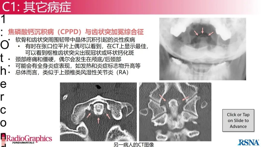 影像PPT - 【PPT】颈椎X线片解读-34 影像PPT - 【PPT】颈椎X线片解读-34