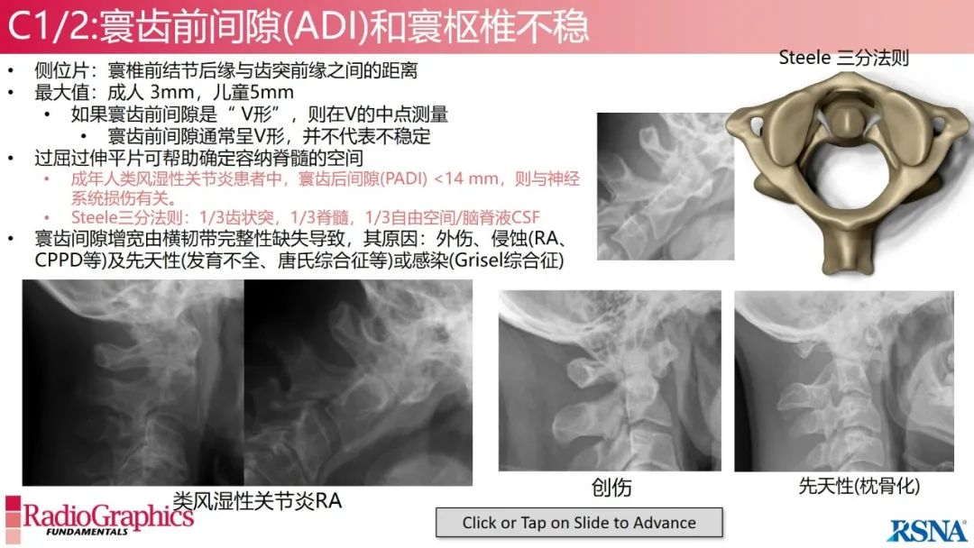 影像PPT - 【PPT】颈椎X线片解读-36 影像PPT - 【PPT】颈椎X线片解读-36