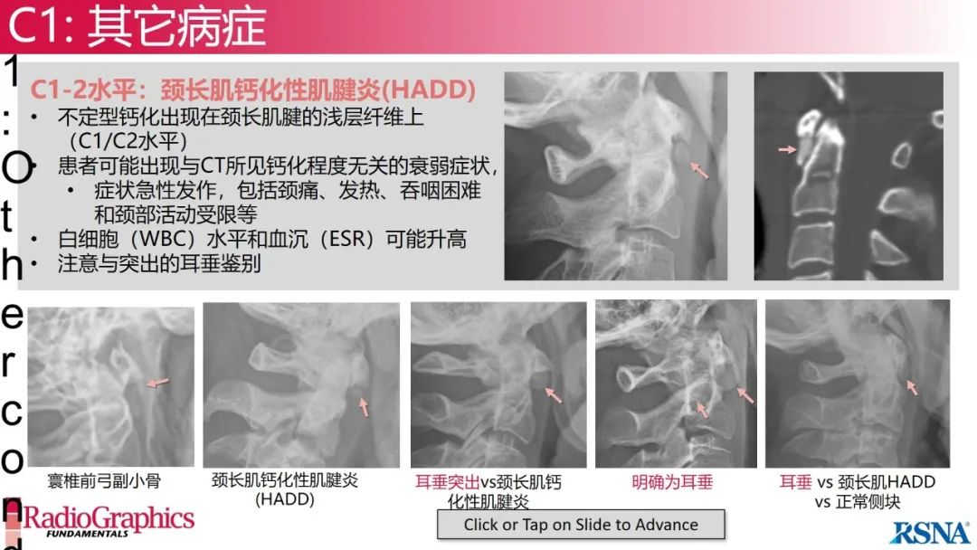 影像PPT - 【PPT】颈椎X线片解读-32 影像PPT - 【PPT】颈椎X线片解读-32