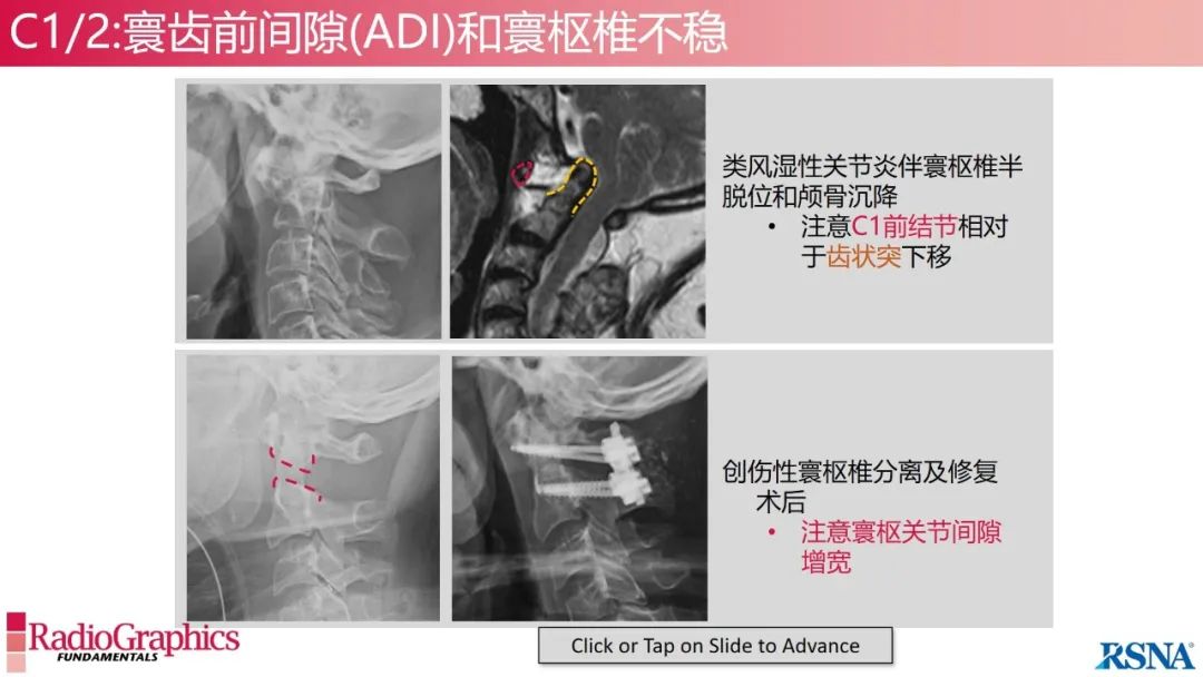影像PPT - 【PPT】颈椎X线片解读-44 影像PPT - 【PPT】颈椎X线片解读-44