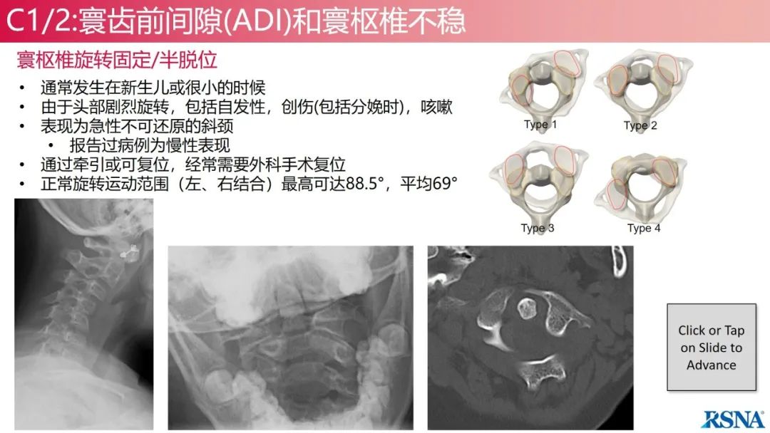 影像PPT - 【PPT】颈椎X线片解读-46 影像PPT - 【PPT】颈椎X线片解读-46