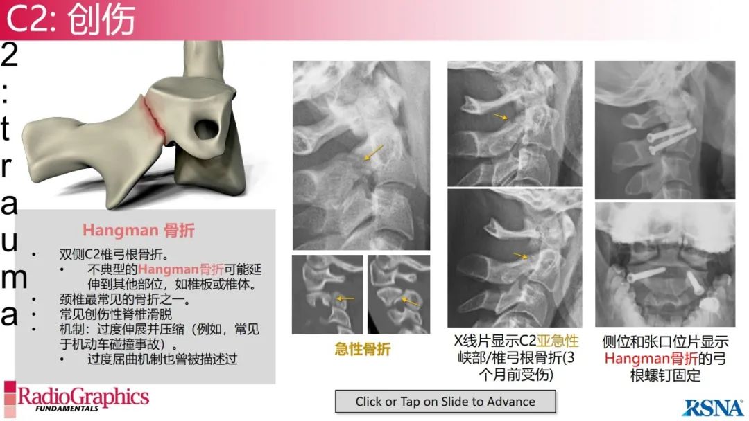 影像PPT - 【PPT】颈椎X线片解读-58 影像PPT - 【PPT】颈椎X线片解读-58