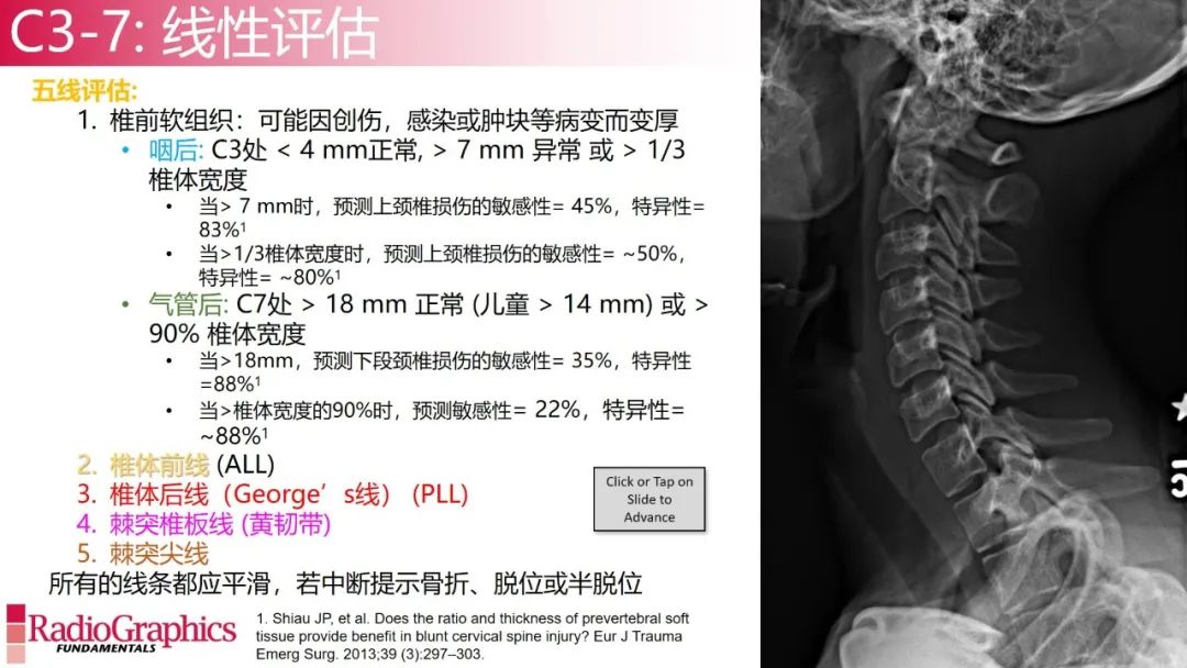 影像PPT - 【PPT】颈椎X线片解读-60 影像PPT - 【PPT】颈椎X线片解读-60