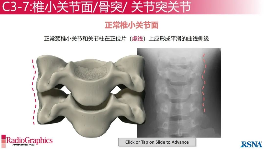 影像PPT - 【PPT】颈椎X线片解读-64 影像PPT - 【PPT】颈椎X线片解读-64