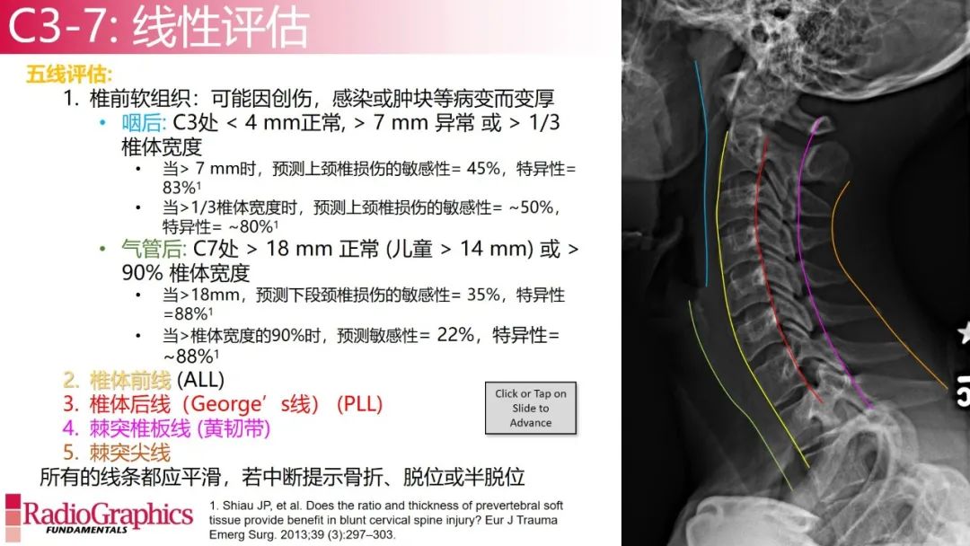 影像PPT - 【PPT】颈椎X线片解读-62 影像PPT - 【PPT】颈椎X线片解读-62