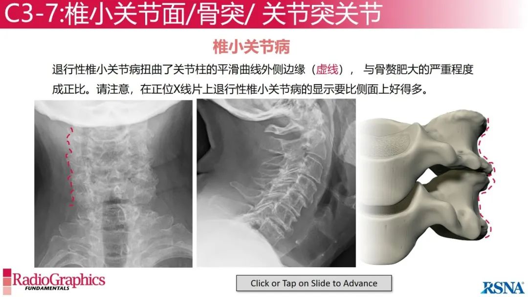 影像PPT - 【PPT】颈椎X线片解读-66 影像PPT - 【PPT】颈椎X线片解读-66