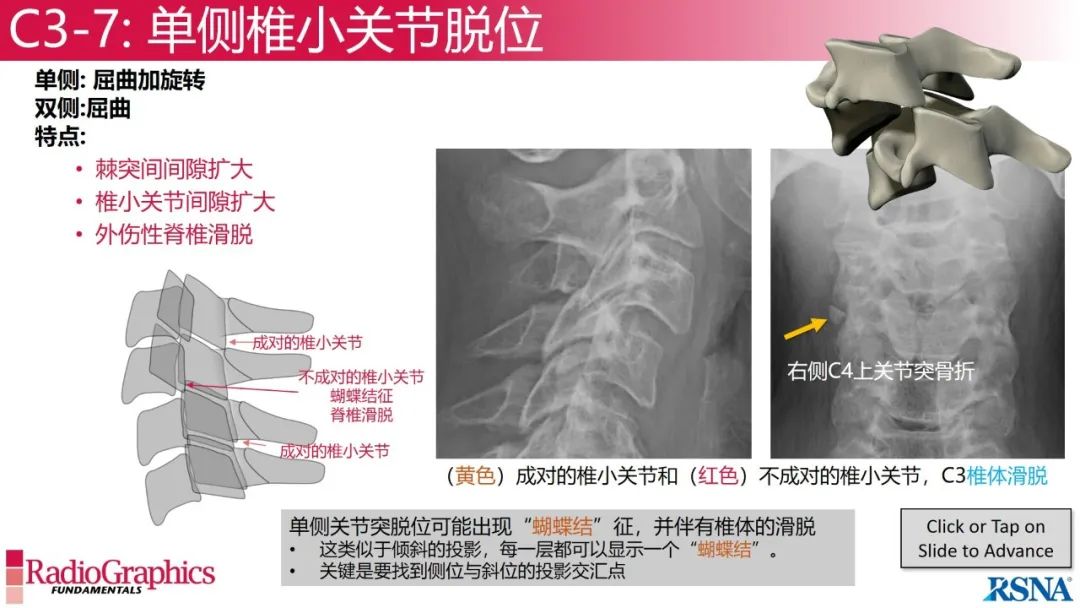 影像PPT - 【PPT】颈椎X线片解读-68 影像PPT - 【PPT】颈椎X线片解读-68