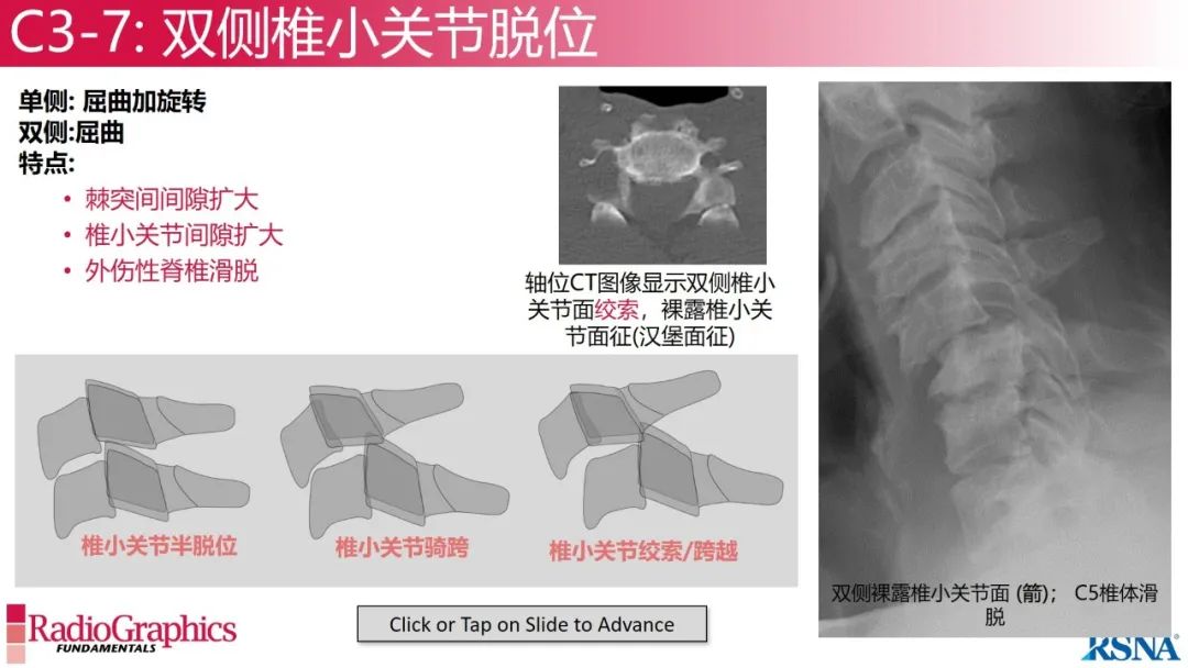 影像PPT - 【PPT】颈椎X线片解读-72 影像PPT - 【PPT】颈椎X线片解读-72