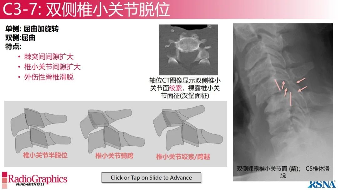 影像PPT - 【PPT】颈椎X线片解读-74 影像PPT - 【PPT】颈椎X线片解读-74