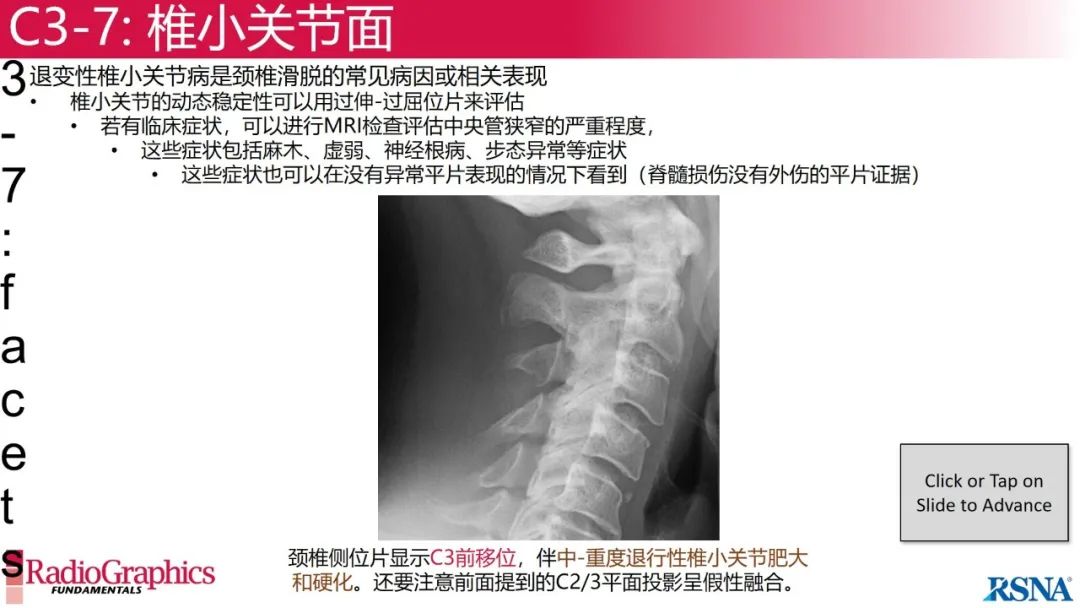 影像PPT - 【PPT】颈椎X线片解读-76 影像PPT - 【PPT】颈椎X线片解读-76