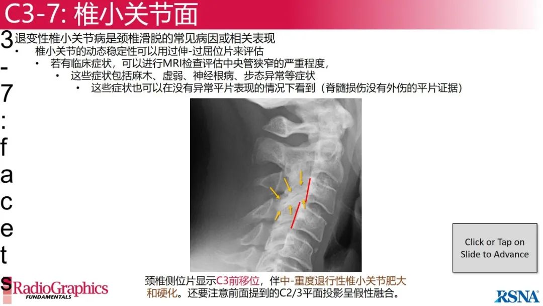 影像PPT - 【PPT】颈椎X线片解读-78 影像PPT - 【PPT】颈椎X线片解读-78