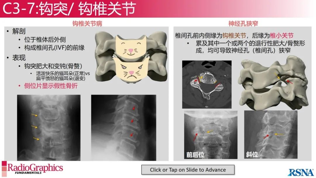 影像PPT - 【PPT】颈椎X线片解读-82 影像PPT - 【PPT】颈椎X线片解读-82