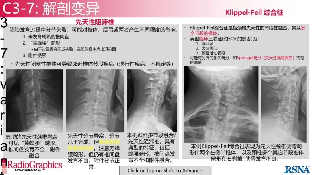 影像PPT - 【PPT】颈椎X线片解读-84 影像PPT - 【PPT】颈椎X线片解读-84