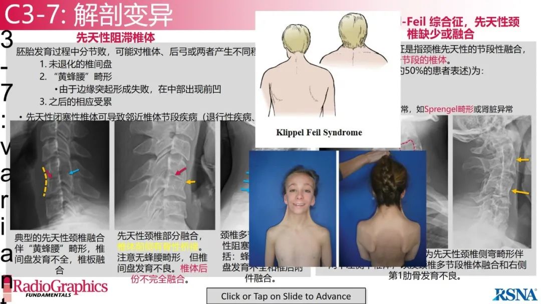 影像PPT - 【PPT】颈椎X线片解读-89 影像PPT - 【PPT】颈椎X线片解读-89