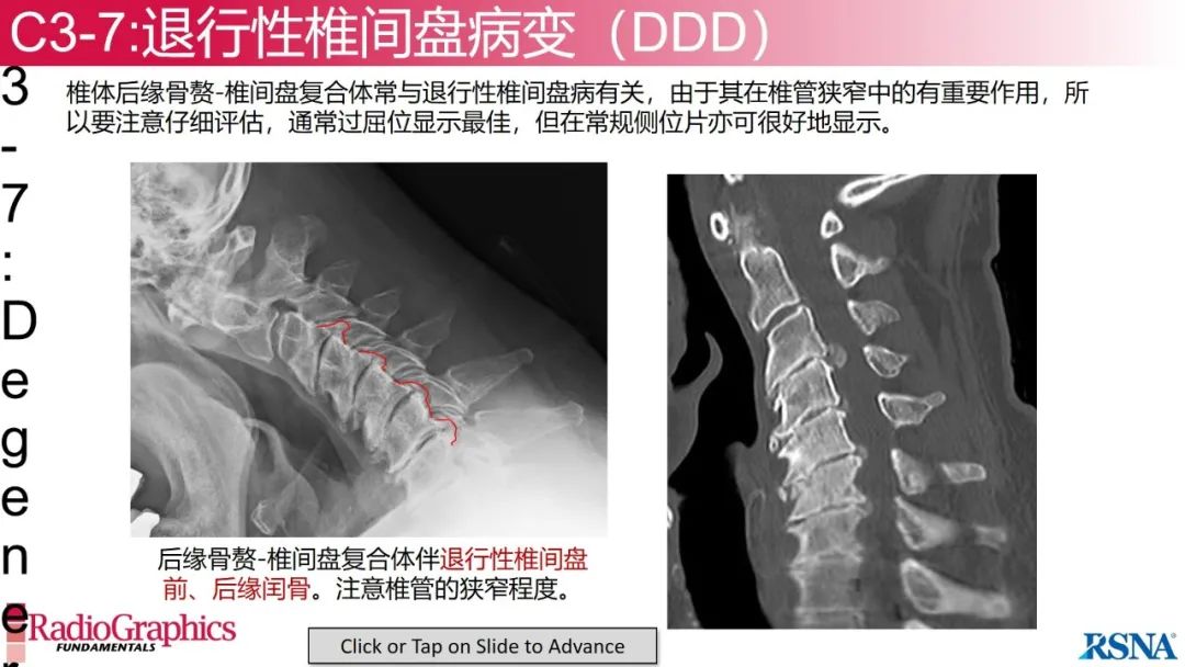 影像PPT - 【PPT】颈椎X线片解读-95 影像PPT - 【PPT】颈椎X线片解读-95