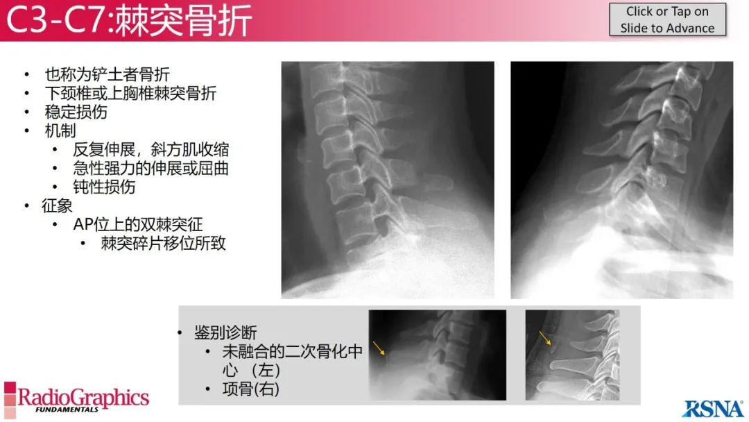 影像PPT - 【PPT】颈椎X线片解读-103 影像PPT - 【PPT】颈椎X线片解读-103