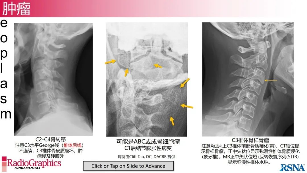影像PPT - 【PPT】颈椎X线片解读-127 影像PPT - 【PPT】颈椎X线片解读-127