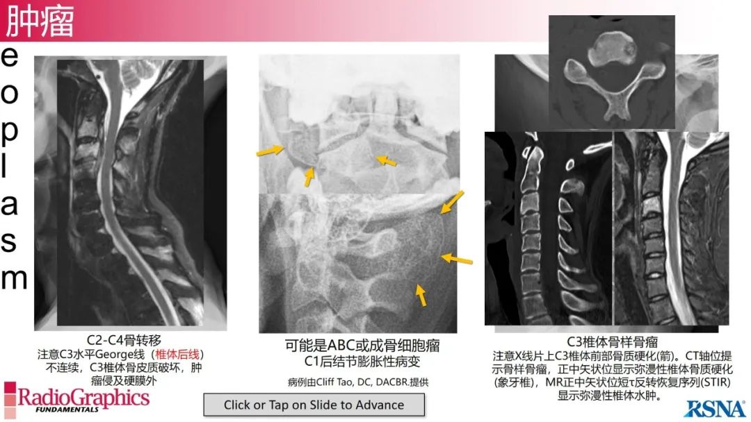影像PPT - 【PPT】颈椎X线片解读-129 影像PPT - 【PPT】颈椎X线片解读-129