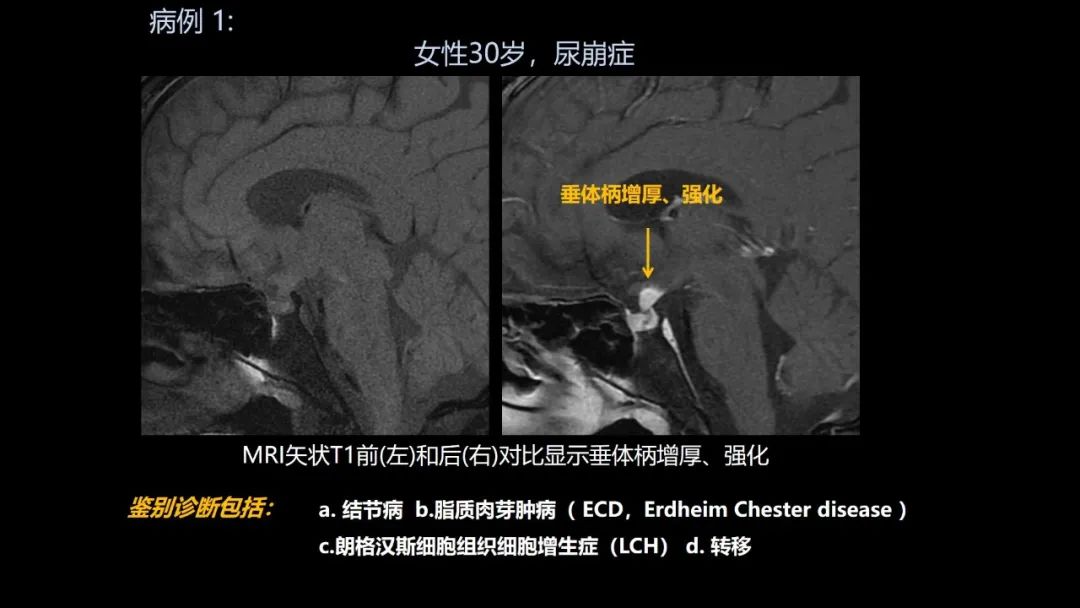 影像PPT - 【PPT】共通之处:同时累及中枢神经系统和心肺系统的疾病-6 影像PPT - 【PPT】共通之处:同时累及中枢神经系统和心肺系统的疾病-6