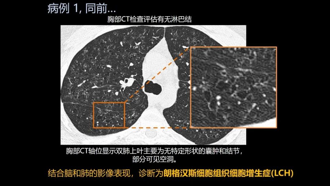 影像PPT - 【PPT】共通之处:同时累及中枢神经系统和心肺系统的疾病-8 影像PPT - 【PPT】共通之处:同时累及中枢神经系统和心肺系统的疾病-8