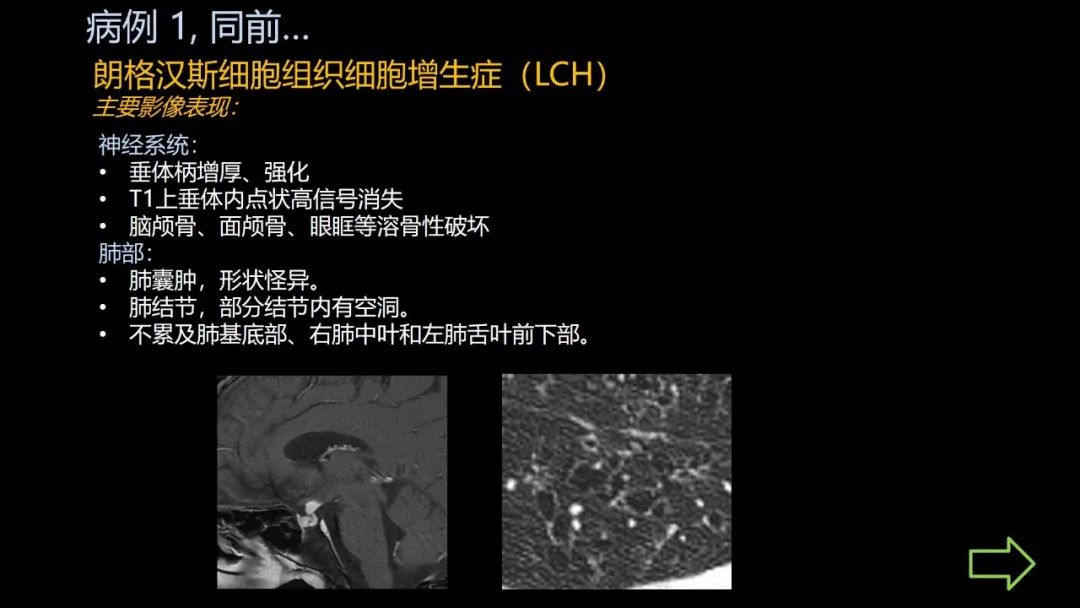影像PPT - 【PPT】共通之处:同时累及中枢神经系统和心肺系统的疾病-10 影像PPT - 【PPT】共通之处:同时累及中枢神经系统和心肺系统的疾病-10