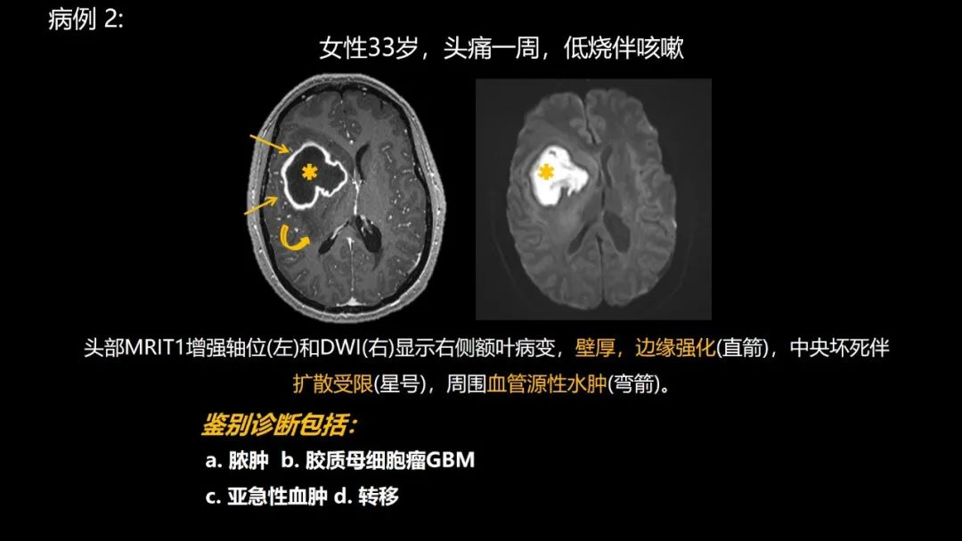 影像PPT - 【PPT】共通之处:同时累及中枢神经系统和心肺系统的疾病-12 影像PPT - 【PPT】共通之处:同时累及中枢神经系统和心肺系统的疾病-12