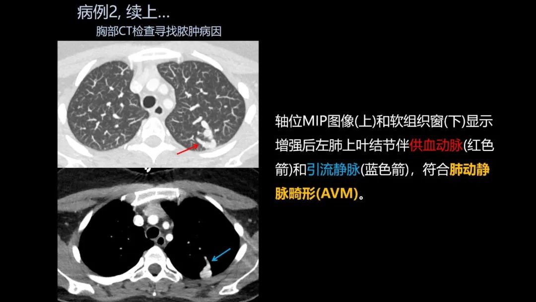 影像PPT - 【PPT】共通之处:同时累及中枢神经系统和心肺系统的疾病-14 影像PPT - 【PPT】共通之处:同时累及中枢神经系统和心肺系统的疾病-14