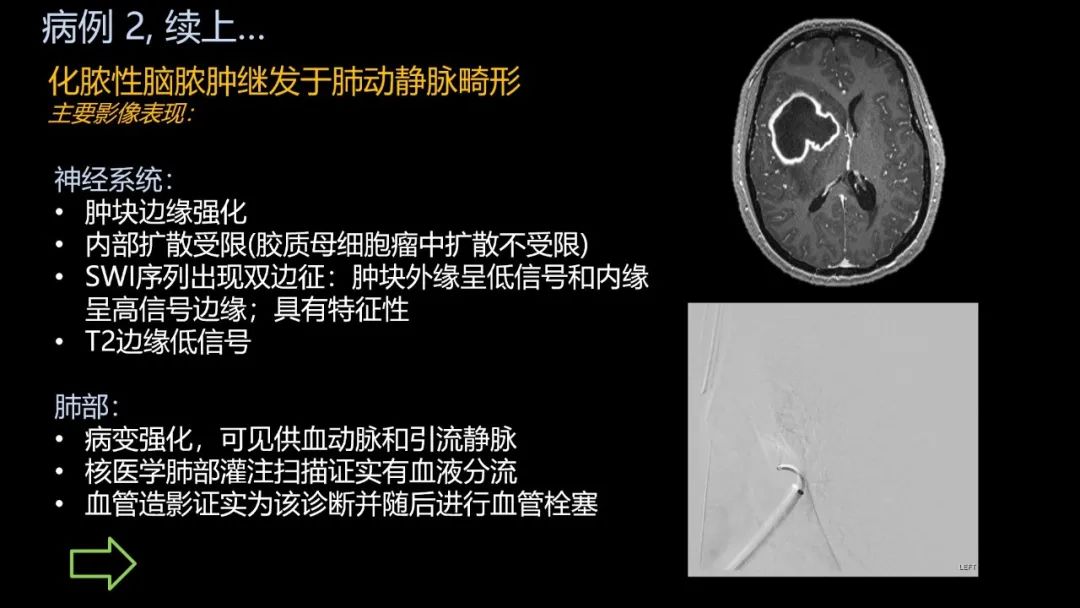影像PPT - 【PPT】共通之处:同时累及中枢神经系统和心肺系统的疾病-17 影像PPT - 【PPT】共通之处:同时累及中枢神经系统和心肺系统的疾病-17