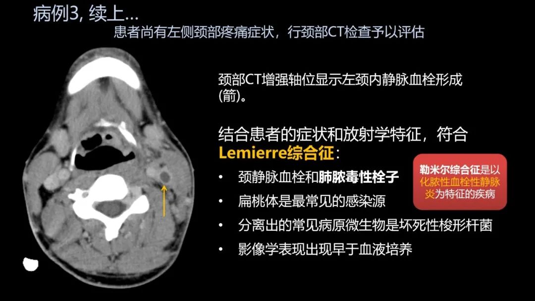 影像PPT - 【PPT】共通之处:同时累及中枢神经系统和心肺系统的疾病-21 影像PPT - 【PPT】共通之处:同时累及中枢神经系统和心肺系统的疾病-21