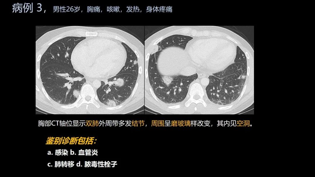 影像PPT - 【PPT】共通之处:同时累及中枢神经系统和心肺系统的疾病-19 影像PPT - 【PPT】共通之处:同时累及中枢神经系统和心肺系统的疾病-19