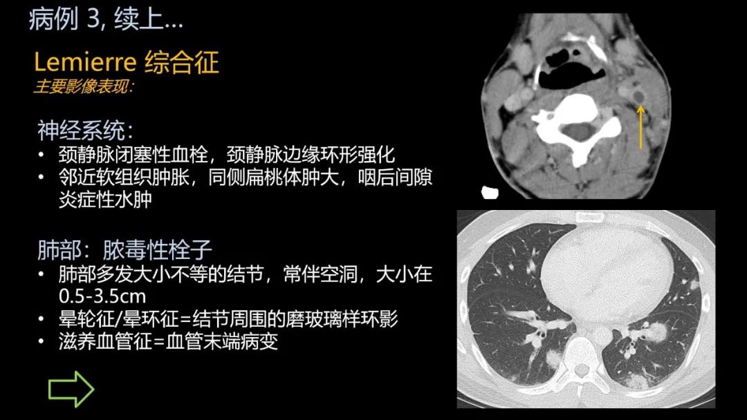 影像PPT - 【PPT】共通之处:同时累及中枢神经系统和心肺系统的疾病-23 影像PPT - 【PPT】共通之处:同时累及中枢神经系统和心肺系统的疾病-23