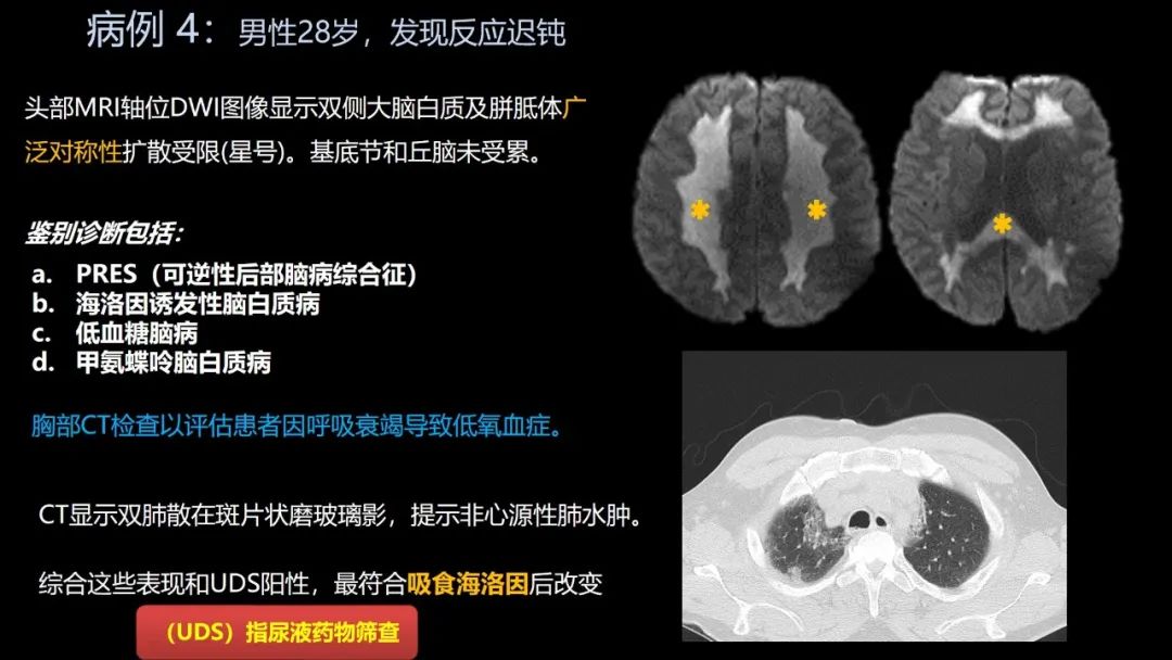 影像PPT - 【PPT】共通之处:同时累及中枢神经系统和心肺系统的疾病-25 影像PPT - 【PPT】共通之处:同时累及中枢神经系统和心肺系统的疾病-25