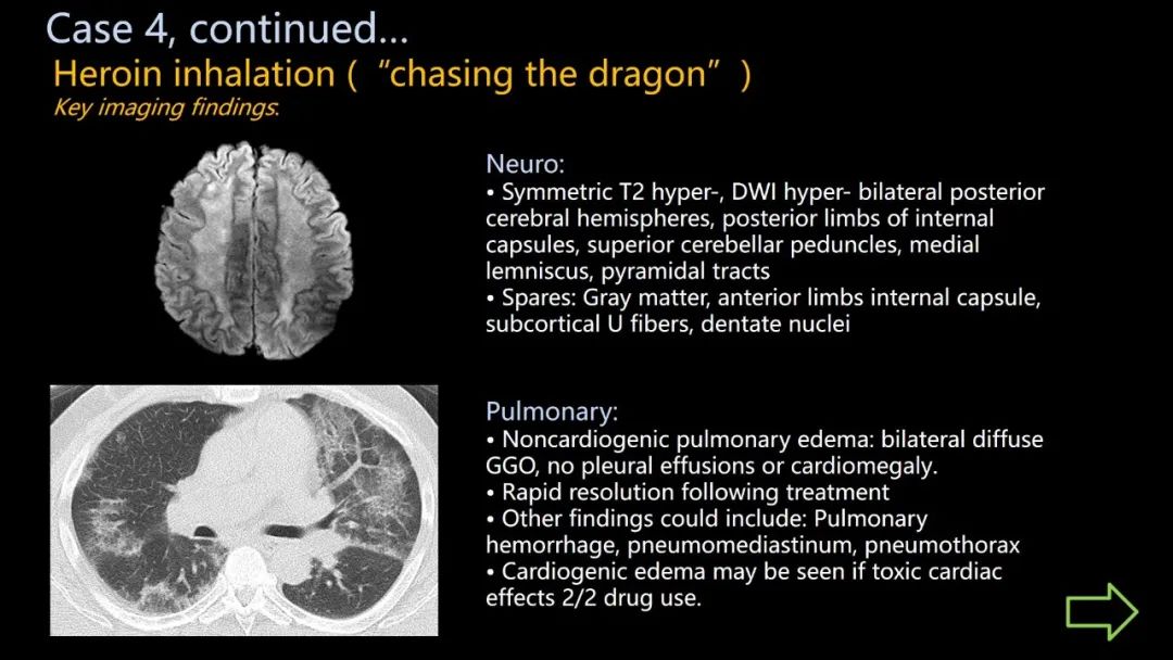 影像PPT - 【PPT】共通之处:同时累及中枢神经系统和心肺系统的疾病-26 影像PPT - 【PPT】共通之处:同时累及中枢神经系统和心肺系统的疾病-26