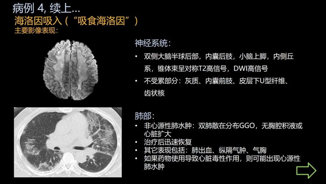 影像PPT - 【PPT】共通之处:同时累及中枢神经系统和心肺系统的疾病-27 影像PPT - 【PPT】共通之处:同时累及中枢神经系统和心肺系统的疾病-27