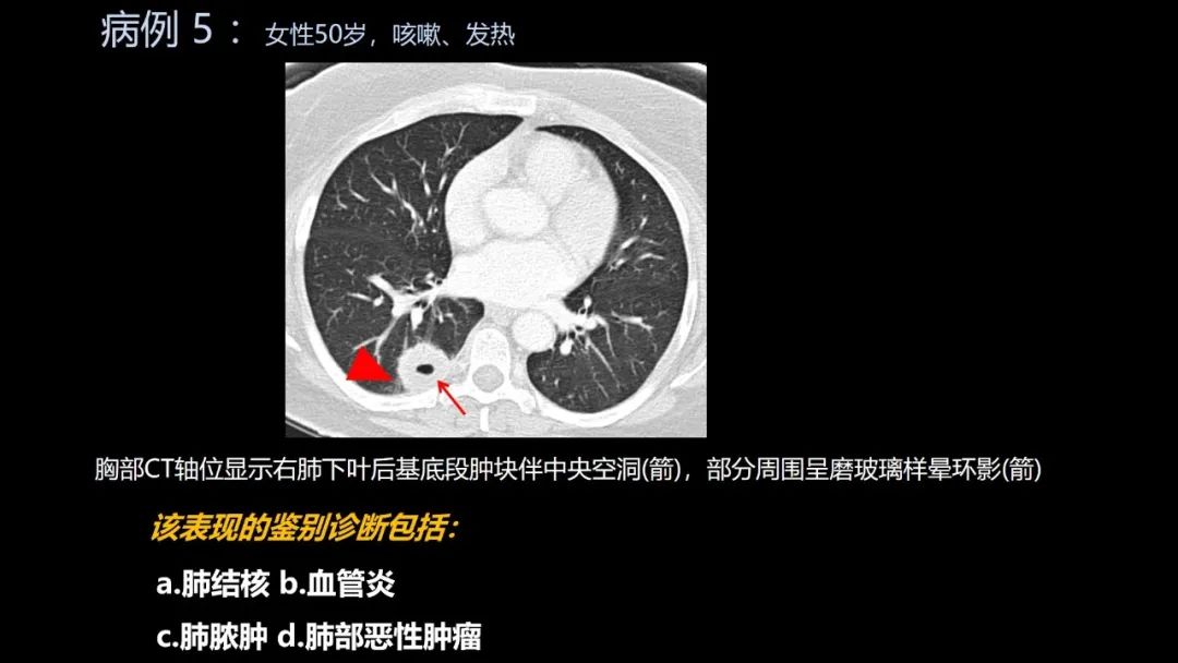 影像PPT - 【PPT】共通之处:同时累及中枢神经系统和心肺系统的疾病-29 影像PPT - 【PPT】共通之处:同时累及中枢神经系统和心肺系统的疾病-29