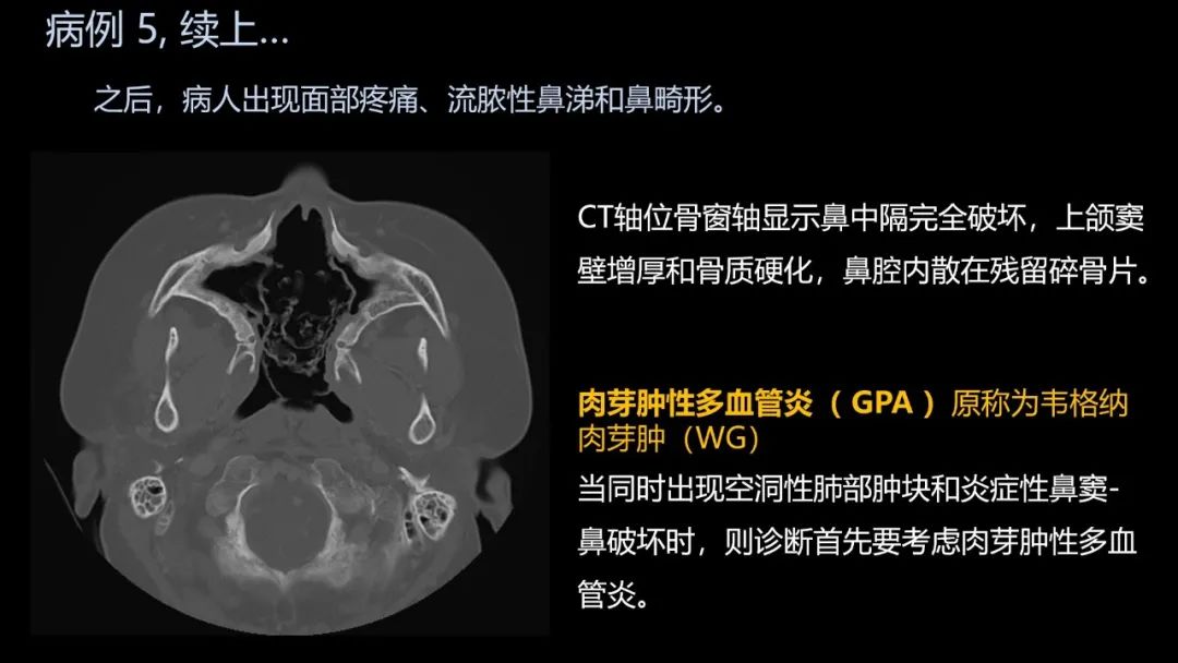 影像PPT - 【PPT】共通之处:同时累及中枢神经系统和心肺系统的疾病-31 影像PPT - 【PPT】共通之处:同时累及中枢神经系统和心肺系统的疾病-31