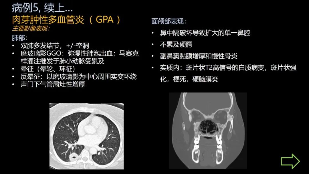 影像PPT - 【PPT】共通之处:同时累及中枢神经系统和心肺系统的疾病-33 影像PPT - 【PPT】共通之处:同时累及中枢神经系统和心肺系统的疾病-33